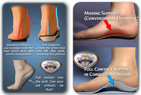 What Is Piriformis Syndrome? - MASS4D® Foot Orthotics